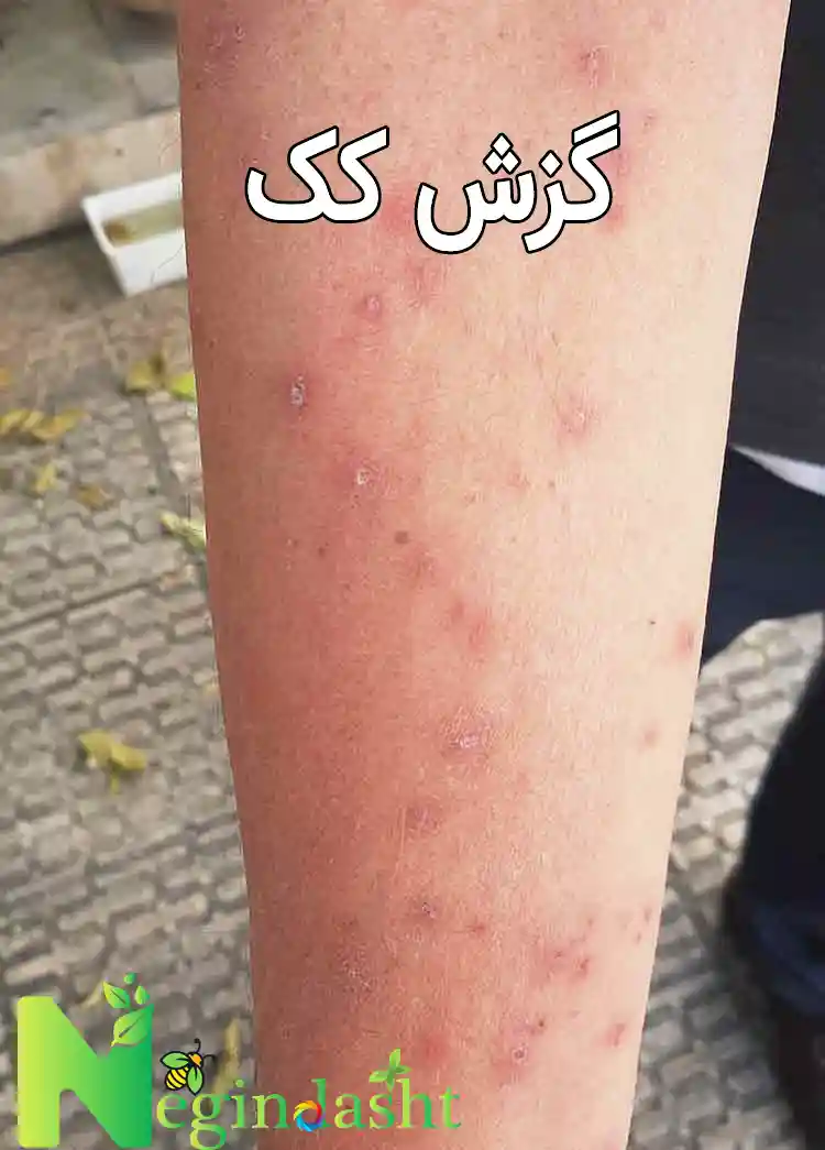 گزش کک