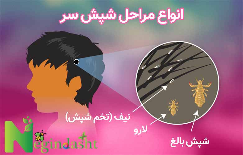 head lice negindasht