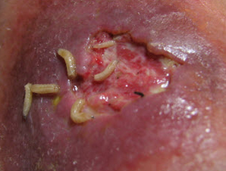 Treatment of infectious ulcers with fly larvae