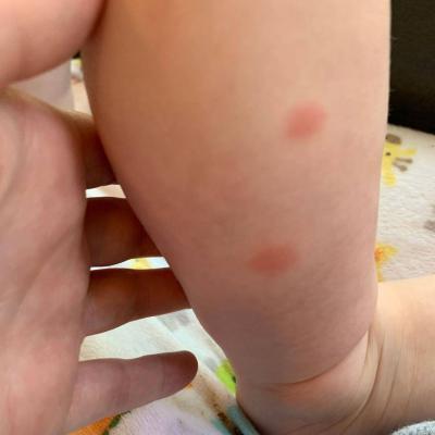 Bedbug Bites 5