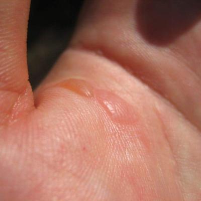 Spider Bites 1