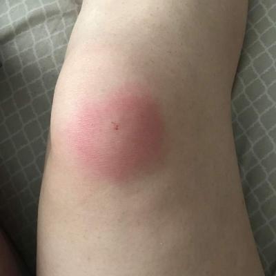 Spider Bites 2