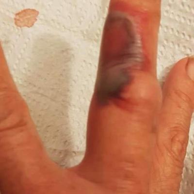 Spider Bites 3