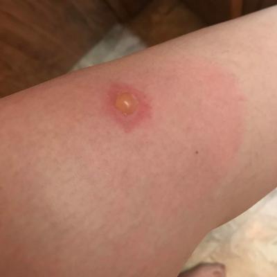 Spider Bites 4
