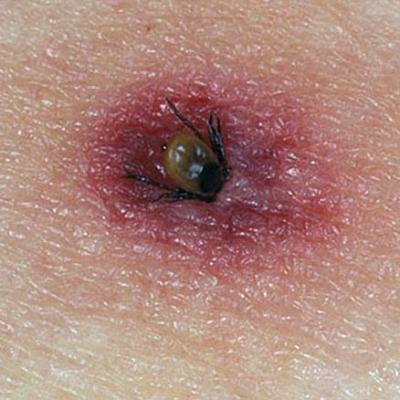 Tick Bite 1