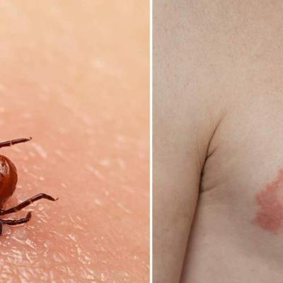 Tick Bite 2
