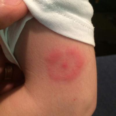 Tick Bite 4