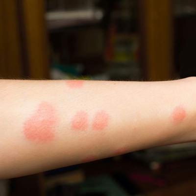 Flea Bites 1