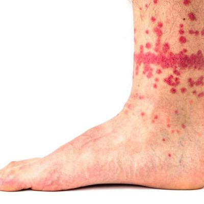 Flea Bites 3