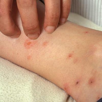 Flea Bites 4