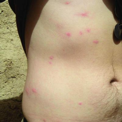 Flea Bites 