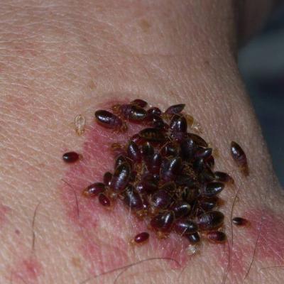 Bedbug Bites 3